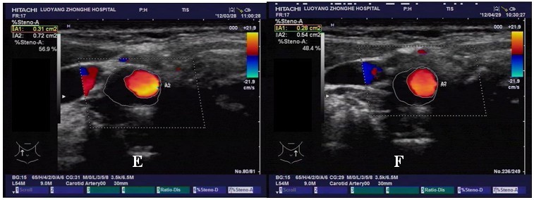 经皮超声消融颈动脉硬化斑块疗效的初步观察